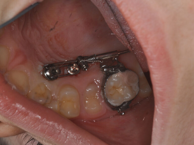 ancoraggio-scheletrico-1