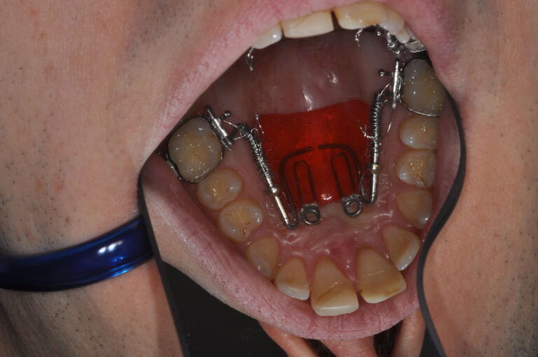 ancoraggio-scheletrico-3